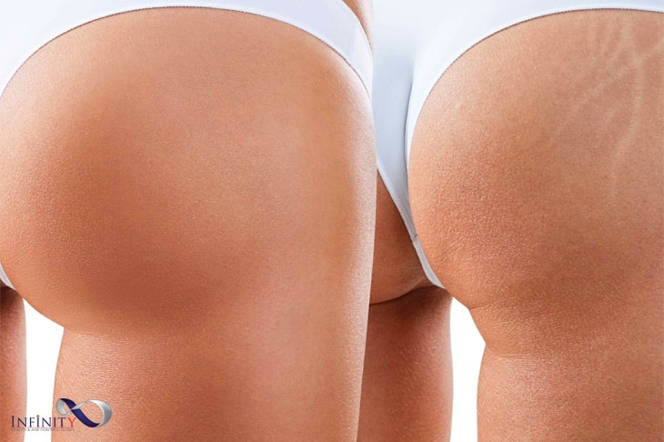 ЛАЗЕРНО ПРЕМАХВАНЕ НА СТРИИ В КЛИНИКА INFINITY 1